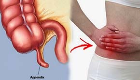 Σκωληκοειδίτιδα (Appendicitis)