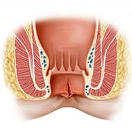 Tzeveleki Surgery anal fissure 1