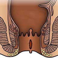 Tzeveleki Surgery anal fissure 2