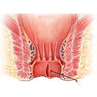 Tzeveleki Surgery anal fissure 3