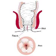 Tzeveleki Surgery anal fissure 4