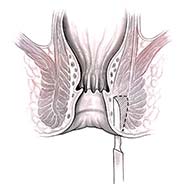 Tzeveleki Surgery anal fissure 6