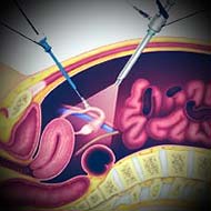Tzeveleki Ioanna Appendicitis 2