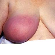 Tzeveleki Surgery breast diseases 2