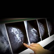 Tzeveleki Surgery breast cancer 1