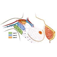 Tzeveleki Surgery breast cancer 4