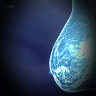 Tzeveleki Surgery breast cancer 2
