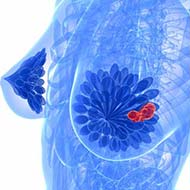 Tzeveleki Surgery breast diseases 3