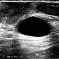 Tzeveleki Surgery breast diseases 1