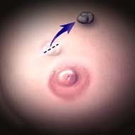 Tzeveleki Surgery Fibroadenomas