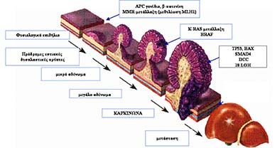 Tzeveleki Surgery Colorectal cancer treatment 3