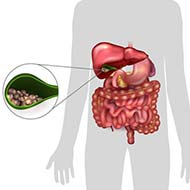 Tzeveleki Surgery cholelithiasis 1