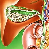 Tzeveleki Surgery cholelithiasis 2