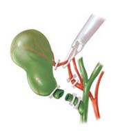 Tzeveleki Surgery cholelithiasis 3