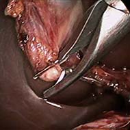 Tzeveleki Surgery cholelithiasis 4