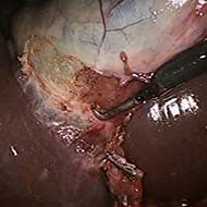 Tzeveleki Surgery cholelithiasis 5