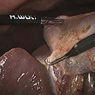 Tzeveleki Surgery cholelithiasis 6