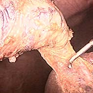 Tzeveleki Surgery cholelithiasis 7
