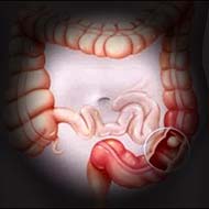 Tzeveleki Surgery Colorectal cancer 1