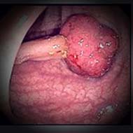 Tzeveleki Surgery Colorectal cancer 2