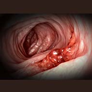Tzeveleki Surgery Colorectal cancer 3