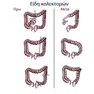 Tzeveleki Surgery Colorectal cancer treatment 1