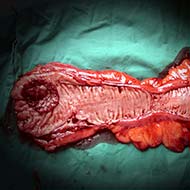 Tzeveleki Surgery Colorectal cancer treatment 2