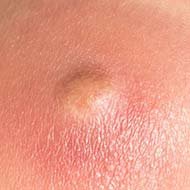Tzeveleki Surgery Sebaceous cyst 1