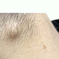 Tzeveleki Surgery Sebaceous cyst 2