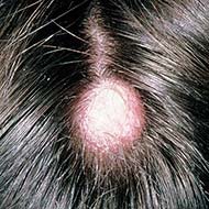 Tzeveleki Surgery Sebaceous cyst 3