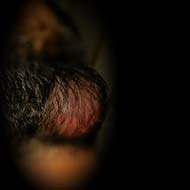 Tzeveleki Surgery Sebaceous cyst 4
