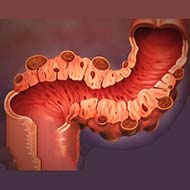 Tzeveleki Surgery Diverticular disease 1