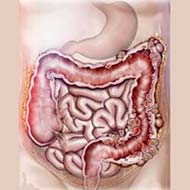 Tzeveleki Surgery Diverticular disease 2