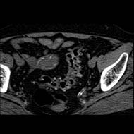 Tzeveleki Surgery Diverticular disease 3