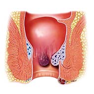 Tzeveleki Surgery Hemorrhoids1