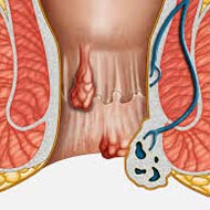 Tzeveleki Surgery Hemorrhoids2