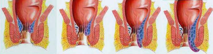 tzeveleki hemorrhoids stages
