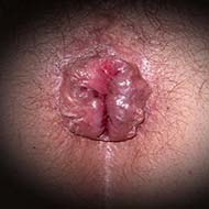 Tzeveleki Surgery Hemorrhoids Symptoms