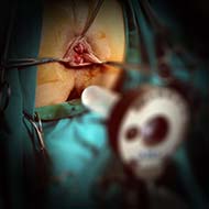 Tzeveleki Surgery Hemorrhoid Artery Ligation 1