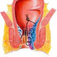 Tzeveleki Surgery Hemorrhoid Artery Ligation 2