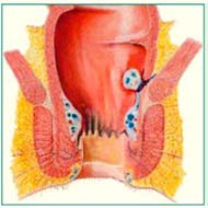 Tzeveleki Surgery Hemorrhoid Artery Ligation 3
