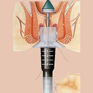 Tzeveleki Surgery Longo method 1
