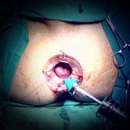Tzeveleki Surgery Longo method 2