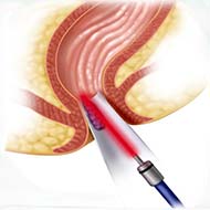 Tzeveleki Surgery LeHP method 1