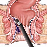Tzeveleki Surgery LeHP method 2