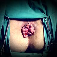 Tzeveleki Surgery Milligan-Morgan method 1