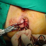Tzeveleki Surgery Milligan-Morgan method 2
