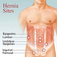 Tzeveleki Surgery hernias 1