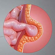 Tzeveleki Surgery Umbilical hernia 1