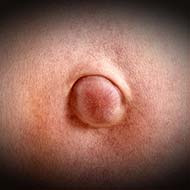 Tzeveleki Surgery Umbilical hernia 2